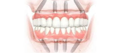 Dental Implants Top and Bottom